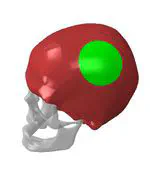 Numerical analysis of human head with implant under impact